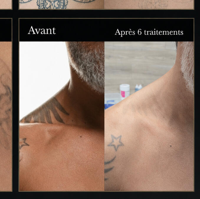Clinique Zen'Art à Donnacona – services de laser et piercing