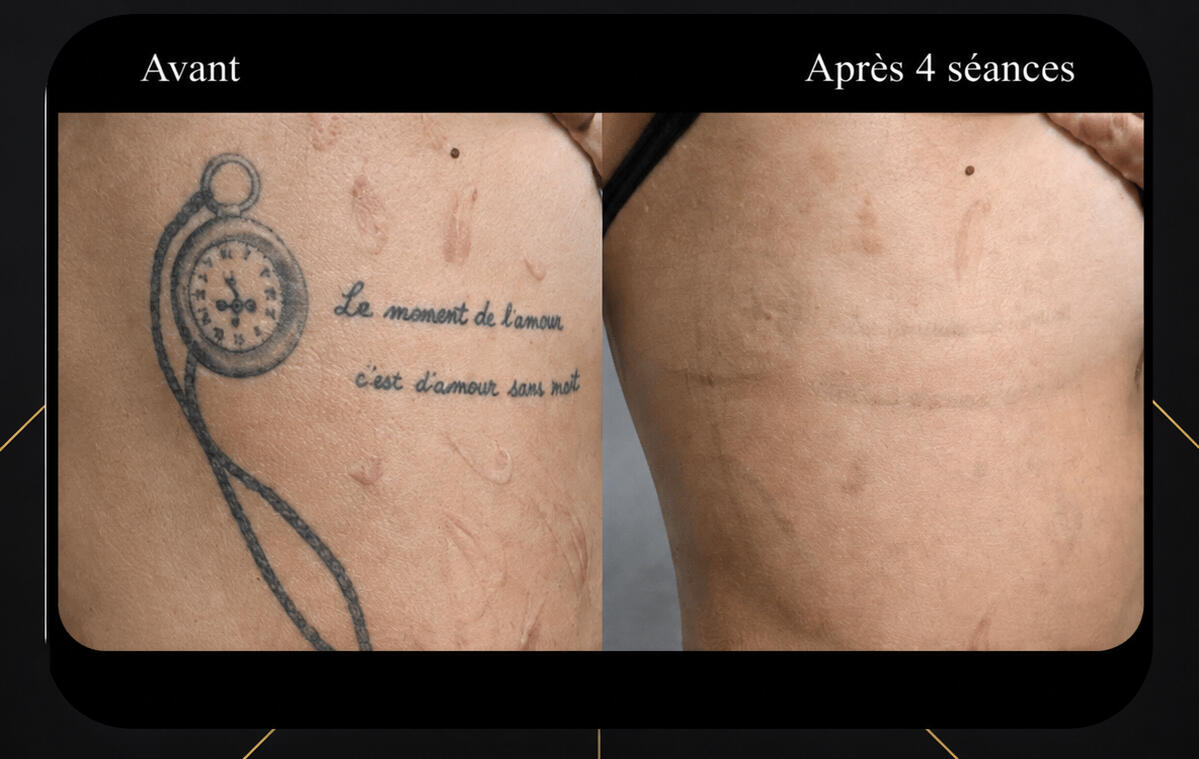 Clinique Zen'Art à Donnacona – services de laser et piercing
