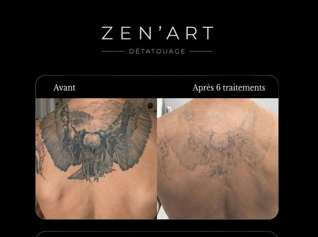 Zen'Art – Clinique dépilation laser, piercing et détatouage à Donnacona Clinique Zen'Art à Donnacona – services de laser et piercing