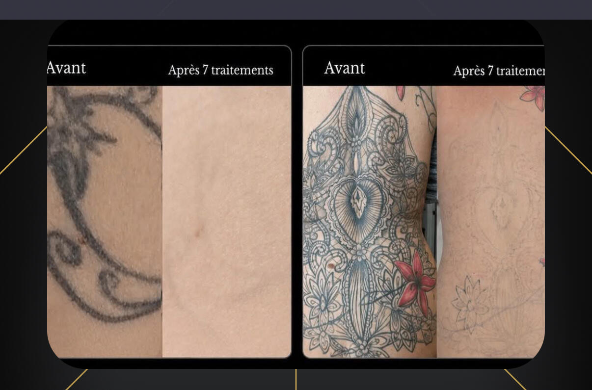 Clinique Zen'Art à Donnacona – services de laser et piercing